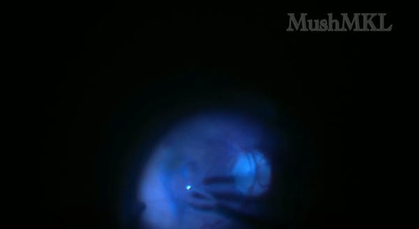 Peripheral Induction of PVD and Peeling of ERM/ILM thumbnail