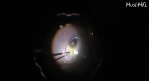 Vitrectomy for a Dislocated IOL Using a Soft Tip