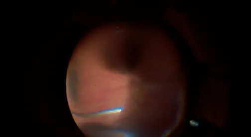 IOL Repositioning With Sutureless Intrascleral Fixation