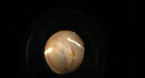 25-Gauge Vitrectomy for Chronic Bullous Exudative Retinal Detachment
