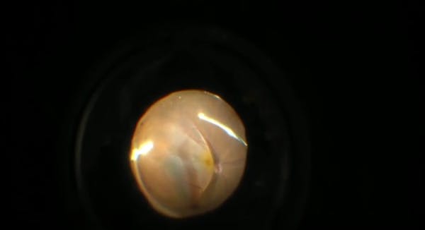 25-Gauge Vitrectomy for Chronic Bullous Exudative Retinal Detachment thumbnail