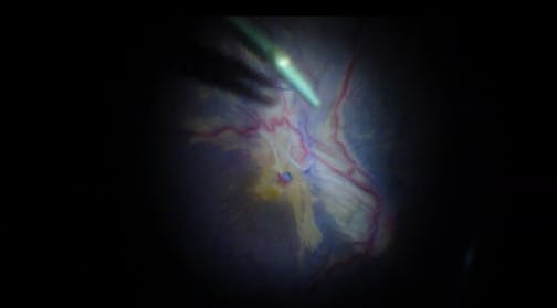 Macular Pucker With Epiretinal and ILM Peel