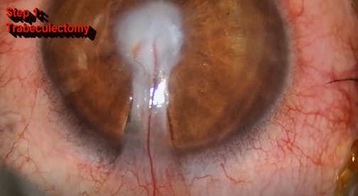 Stepwise Approach of a Complex Cataract-Cornea Case