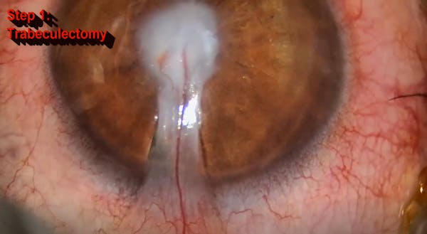Stepwise Approach of a Complex Cataract-Cornea Case thumbnail