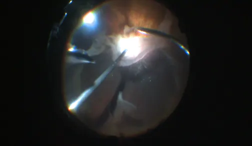 Giant Retinal Tear With Narrow Funnel Configuration