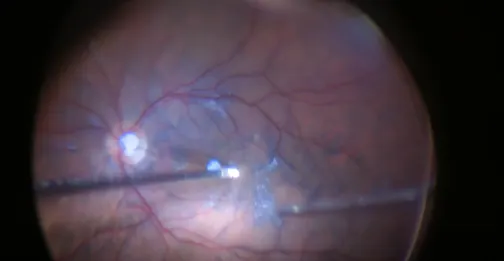 Complete Vitrectomy and ILM Peeling