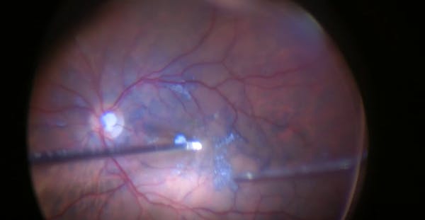 Complete Vitrectomy and ILM Peeling thumbnail