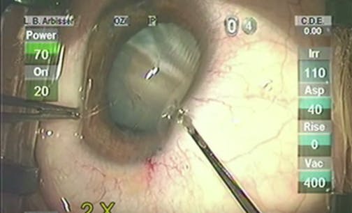 Hypermature Cataract Following Pars Plana Vitrectomy