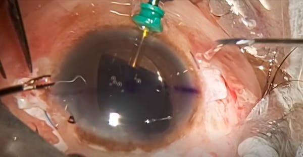 IOL Explantation and Glued IOL thumbnail