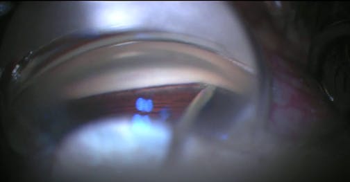 Kahook Dual Blade Teaching Video