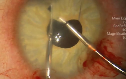 Removal of Bilateral Iris Implants