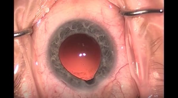 External Tapping of Iris Prolapse thumbnail