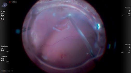 Retinal Transplant Under Oil