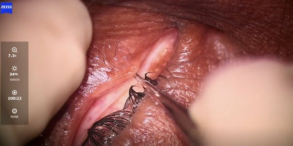 Dextenza Insertion in Small Punctum thumbnail
