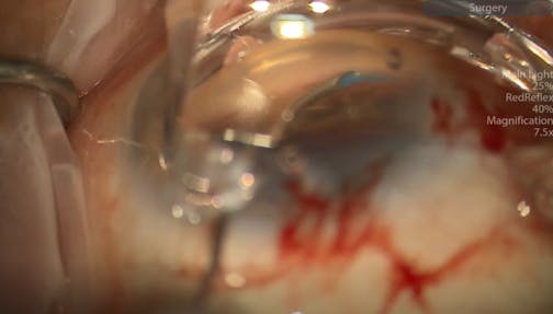 Omni Goniotomy and Viscocanaloplasty