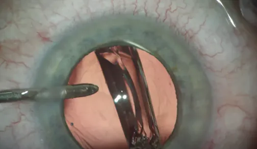 LuxSmart IOL Implantation