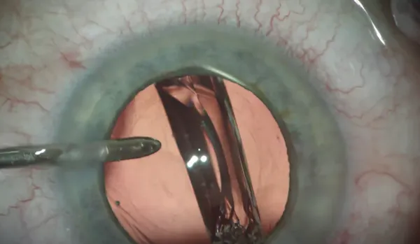 LuxSmart IOL Implantation thumbnail
