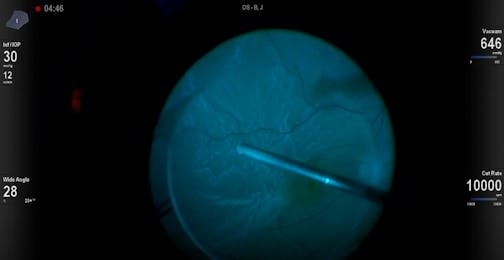 Epiretinal Membrane Peel Under PFO
