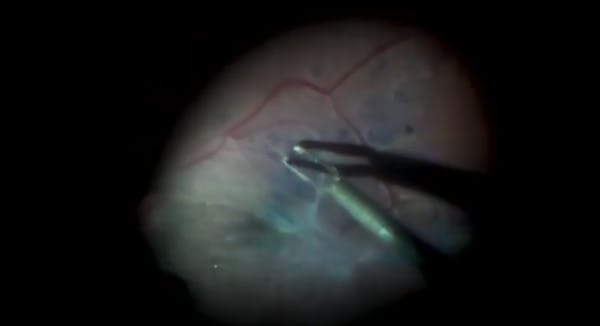 Vitrectomy for Macular Pucker With External Limiting Membrane Peel thumbnail