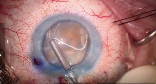 Use of miLoop in an Eye With a Dense Cataract