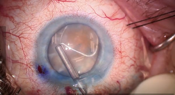 Use of miLoop in an Eye With a Dense Cataract thumbnail