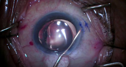 Cataract Surgery and Ab Interno Xen Gel Stent