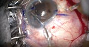 Adjustable Flange Technique for Scleral Fixation of a Single-Piece IOL