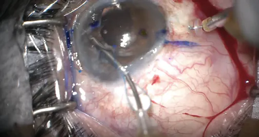 Adjustable Flange Technique for Scleral Fixation of a Single-Piece IOL