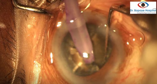 Chopping a Hard Cataract