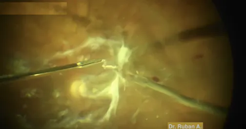 Vitreoschisis in Diabetic Vitrectomy