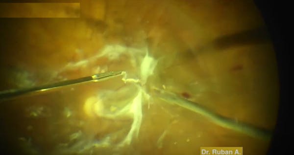 Vitreoschisis in Diabetic Vitrectomy thumbnail