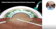 Critical Issues in Pars Plana Lensectomy
