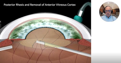 Critical Issues in Pars Plana Lensectomy