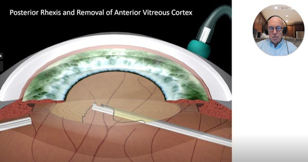 Critical Issues in Pars Plana Vitrectomy thumbnail