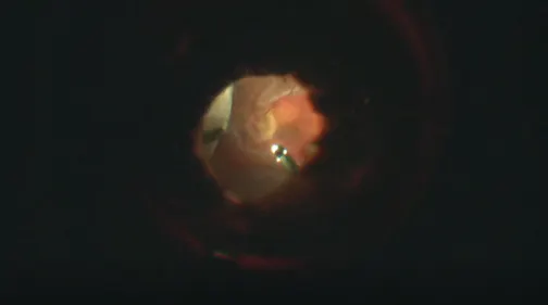 23-Gauge Pars Plana Vitrectomy
