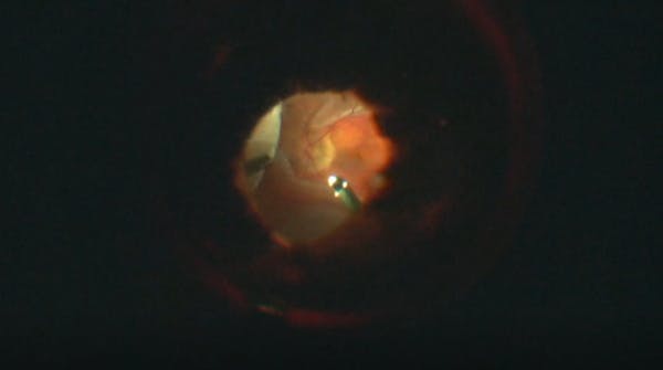 23-Gauge Pars Plana Vitrectomy thumbnail