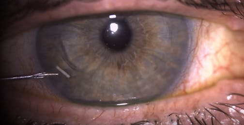 Durysta Injection Using the AC Probe