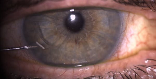 Durysta Injection Using the AC Probe thumbnail
