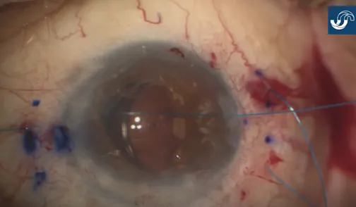 Modified Four-Flanged Scleral Fixation Technique