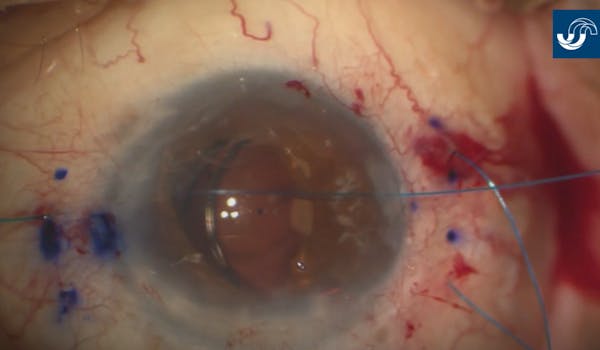 Modified Four-Flanged Scleral Fixation Technique thumbnail