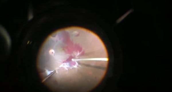 25-Gauge Vitrectomy for Macula-on Combined Tractional and Rhegmatogenous Diabetic Retinal Detachment thumbnail