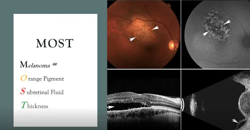 Diagnosis of Small Choroidal Melanoma