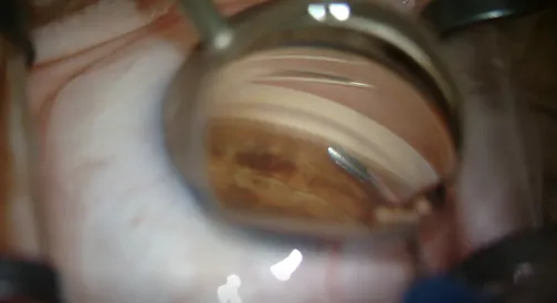 Hydrus Microstent Placement for Open-Angle Glaucoma