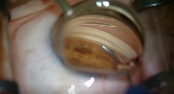 Hydrus Microstent Placement for Open-Angle Glaucoma thumbnail