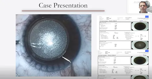 Case-Based Management of Corneal Ectasia