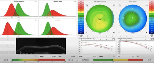 Screening for Ectasia Risk