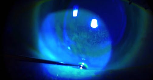 A New Instrument and Technique to Diagnose a Corneal Erosion