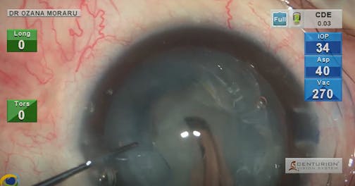 White Intumescent Cataract on Post-Endophthalmitis Vitrectomized Eye