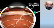 Medium-Term PFO for Inferior Retinal Detachments and Giant Retinal Tears