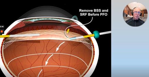 Medium-Term PFO for Inferior Retinal Detachments and Giant Retinal Tears